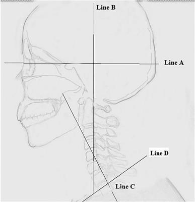 Establish a new parameter “horizontal view-axial angle” and explore its role in the treatment of atlantoaxial instability diseases